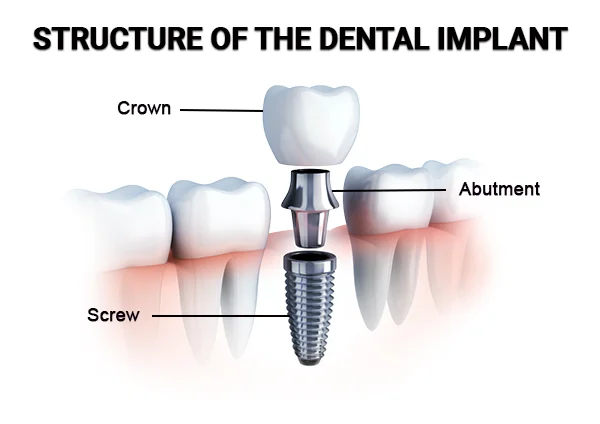 structure of the dental implant
